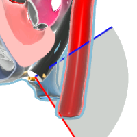 Descending Aorta LAX View