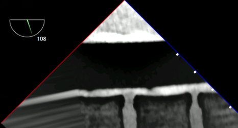 Descending Aorta LAX TEE View