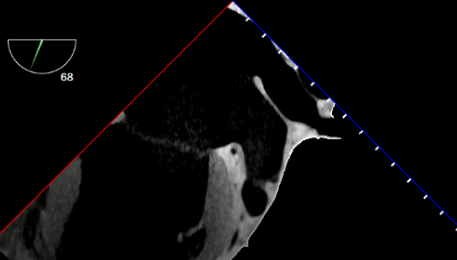 ME Left Atrial Appendage TEE View