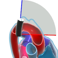 UE Aortic Arch LAX View