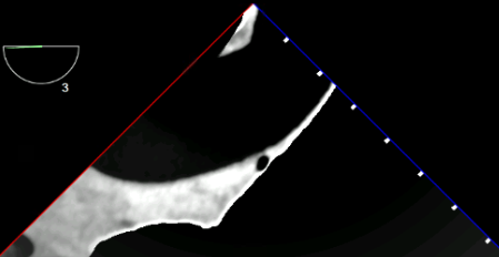 UE Aortic Arch LAX TEE View