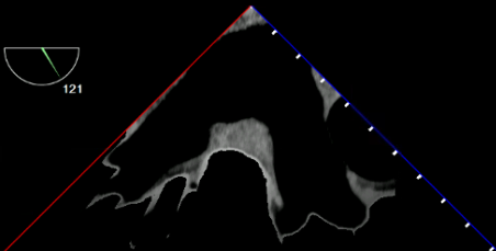 UE Left Pulmonary Veins TEE View