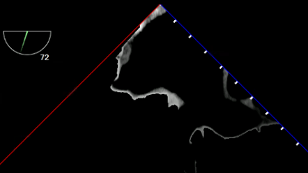 UE Right and Left Pulmonary Veins TEE View